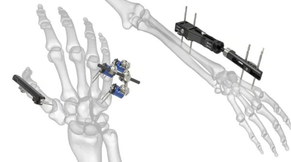 External Fixator – advancemedicalengineering.com